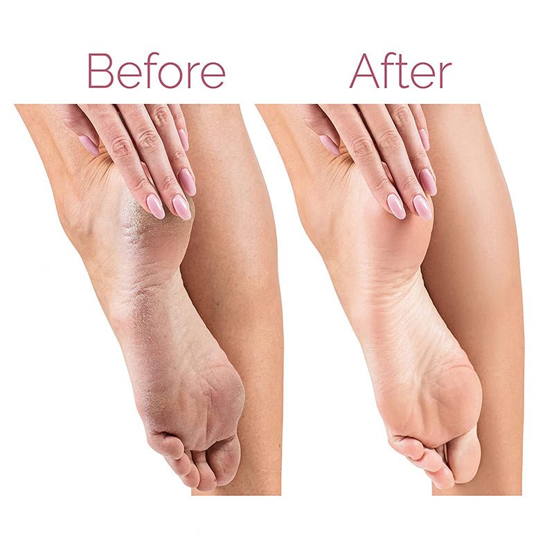 Rechargeable Electric Foot File – Callus & Dead Skin Remover